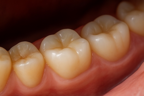 Why Tooth Colored Fillings Are Replacing Silver Fillings