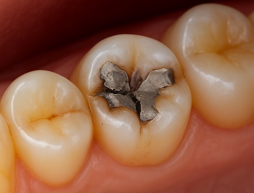 Worn Dental Fillings: Signs, Risks, And When To Seek Treatment